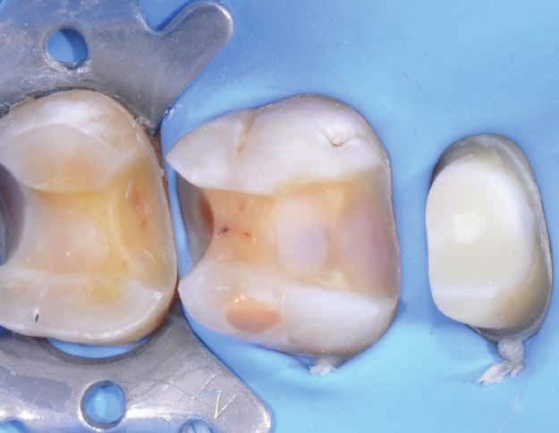 crowns. Learn the following: Silicon index for prep control. Preparation protocols. Frontal teeth upper jaw. Frontal teeth lower jaw.