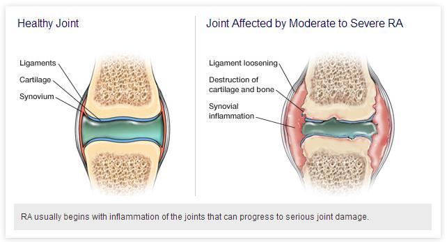 2 What is Arthritis? Arthritis means inflammation of joints.