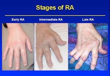 How RA Joint Damage Progresses Without Treatment With the inflammatory process remaining active, the joint lining cells continue to grow and expand, first filling the joint cavity & recess.