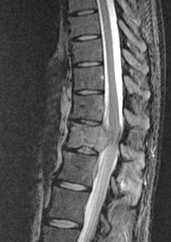 Spinal MRI TUMORAL EPIDURITIS