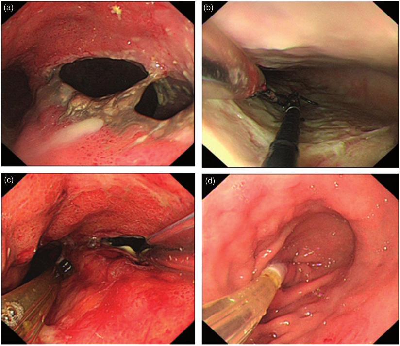 1530 Journal of International Medical Research 46(4) gastrointestinal decompression tube, and thoracic closed drainage tube). The two-tube procedure was accomplished under endoscopy.
