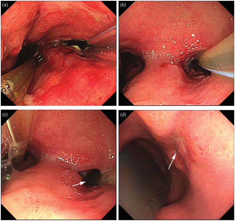 1532 Journal of International Medical Research 46(4) Figure 3. Evolution of esophageal leakage. (a) Endoscopic view of the two-tube placement method.