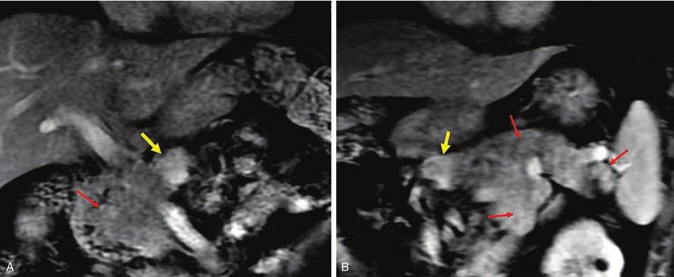Medicine examined with enhanced intraoperative ultrasound (IOUS) to determine the presence and location of pancreatic lesions.