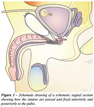 Peritoneal Covering of the Bladder : In male, the superior surface and the superior part of its base is covered by peritoneum, In females, only the superior surface is covered by peritoneum.