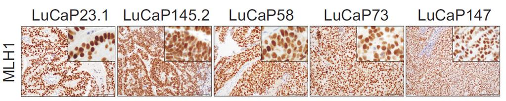 Hypermutated MSI positive cases LuCaP 58, LuCaP 73, LuCaP 147 (top) and autopsy cases 00-010, 03-130, 05-165 (middle), which harbored somatic mutations in MSH2, MSH6 or both have intact MLH1