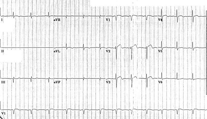 290 Extra practice So you re a glutton for punishment Problem 14: Answers 1. The ECG shows an irregular but reasonably normal heart rate.