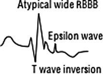 282 Appendix Table 8: Funny waves at the end of the QRS complex Delayed depolarization Right bundle branch block R in V 1 Larger and wider the R the greater the delay/block No ST elevation