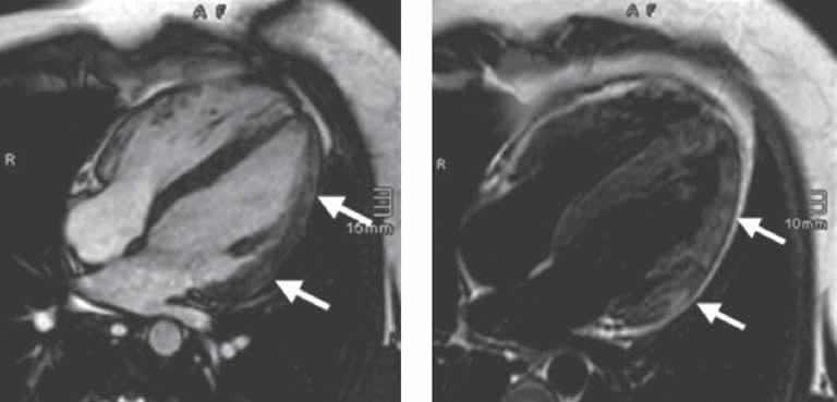 Frank Himmel et al., Influenza myocarditis A B Figure 2. A. Cine steady-state free precession image in four-chamber view acquired during end-diastole. Normal left ventricular volume.