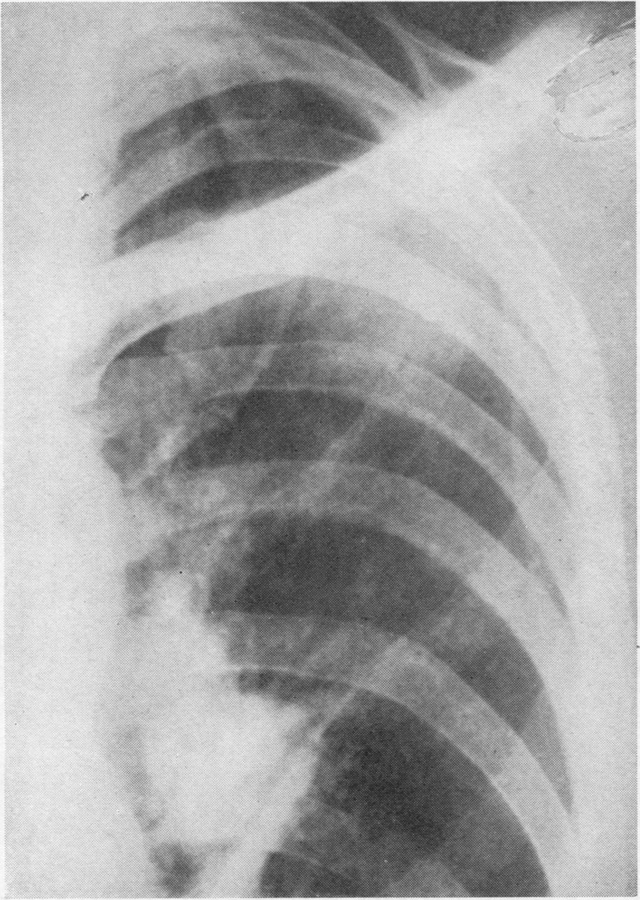 shadow in the axilla just below the clavicle the infarct. FIG. 3.
