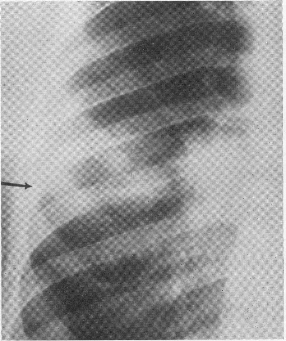 PULMONARY INFARCTS two 1 cm. circular shadows in the outer third of the left upper zone. Tuberculosis was considered a possibility.