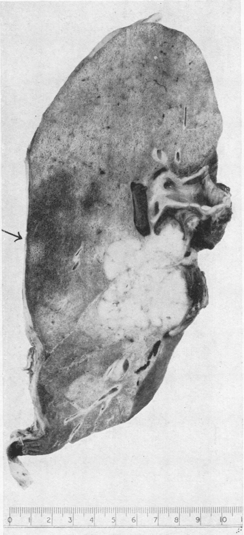 FIG. 12.-Case 5: cut surface of right lung showing carcinoma of middle lobe bronchus and peripheral infarct (arrowed) in anterior segment of upper lobe.