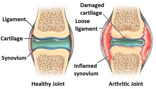 This picture shows the difference between a healthy finger joint (left) and one with arthritis (right). With arthritis, the cartilage that helps protect the end of your joints becomes damaged.