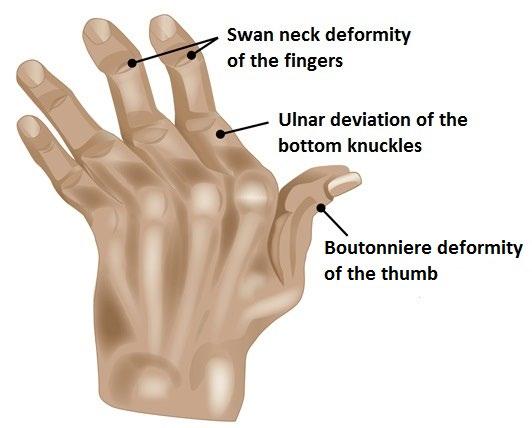 Do not do it again until it is reviewed by your therapist. 6 Avoid positions of deformity Rheumatoid arthritis or osteoarthritis can cause various deformities in your finger joints.