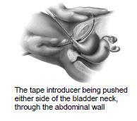 Two small cuts are made in the lower abdominal wall above the pubic bone about 4cm apart.