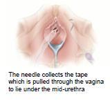 Some women will return from theatre with a urethral catheter to drain the bladder, especially if an additional procedure such as a vaginal repair has been performed at the same time.
