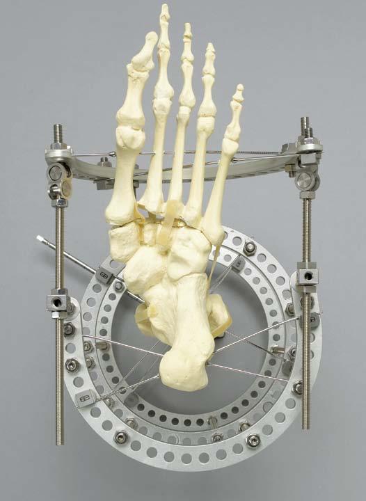 Preoperative Planning Choose the right size: Measure rings to fit the tibia Check foot plates on