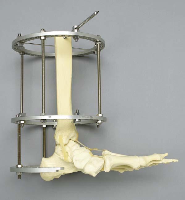 Connect Foot Plate Using 2 threaded rods connect foot plate to the tibial