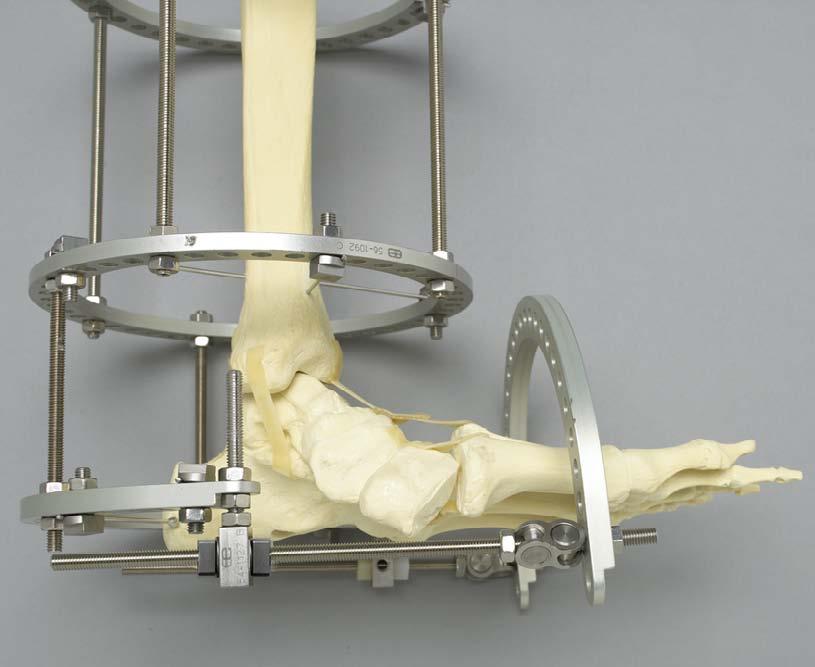 Align Foot Plate with Metatarsals Align foot plate to the axis of the forefoot Secure all the connections