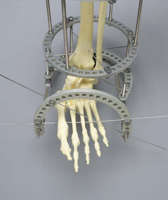 Metatarsal Wires Insert medial metatarsal olive wire through metatarsals 1and 2 Insert lateral