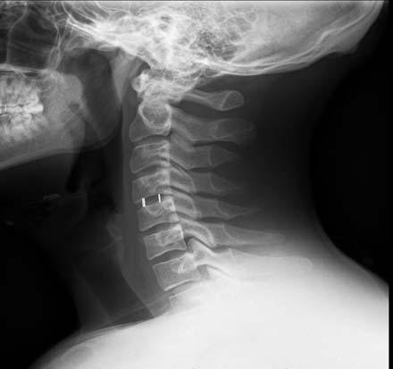 25 years post-operative, the patient complains from neck pain and