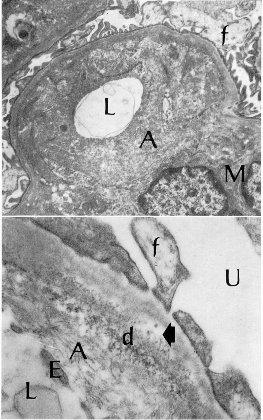 Amyloidosis and Filariasis I83 Fig. 3. Electron micrograph of glomerular capillary of hamster with amyloidosis.