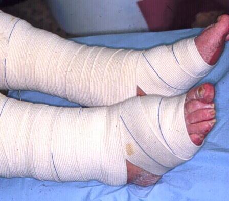 Problem with bandage application on the foot Source: www.