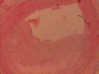 Histologic section of the myocardium showing a cross- section of
