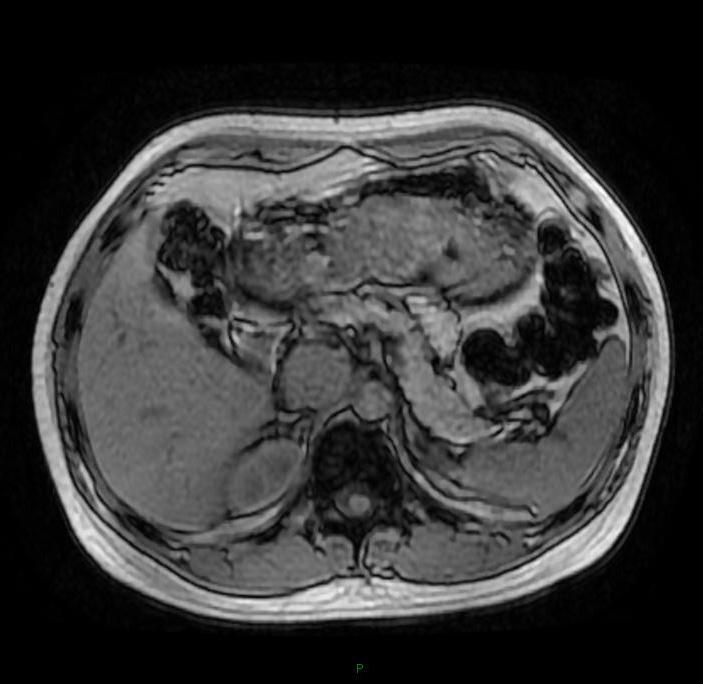 Case Report A rare case of retroperitoneal paraganglioma case report and literature review Peng Li, Dongbing Zhao Department of Abdominal Surgery, Cancer Institute & Hospital, Chinese Academy of