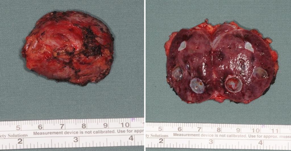 Page 4 of 6 Translational Gastroenterology and Hepatology, 2016 Figure 8 Resected tumor (shows the diameter and cut plane). neuroendocrine cells.
