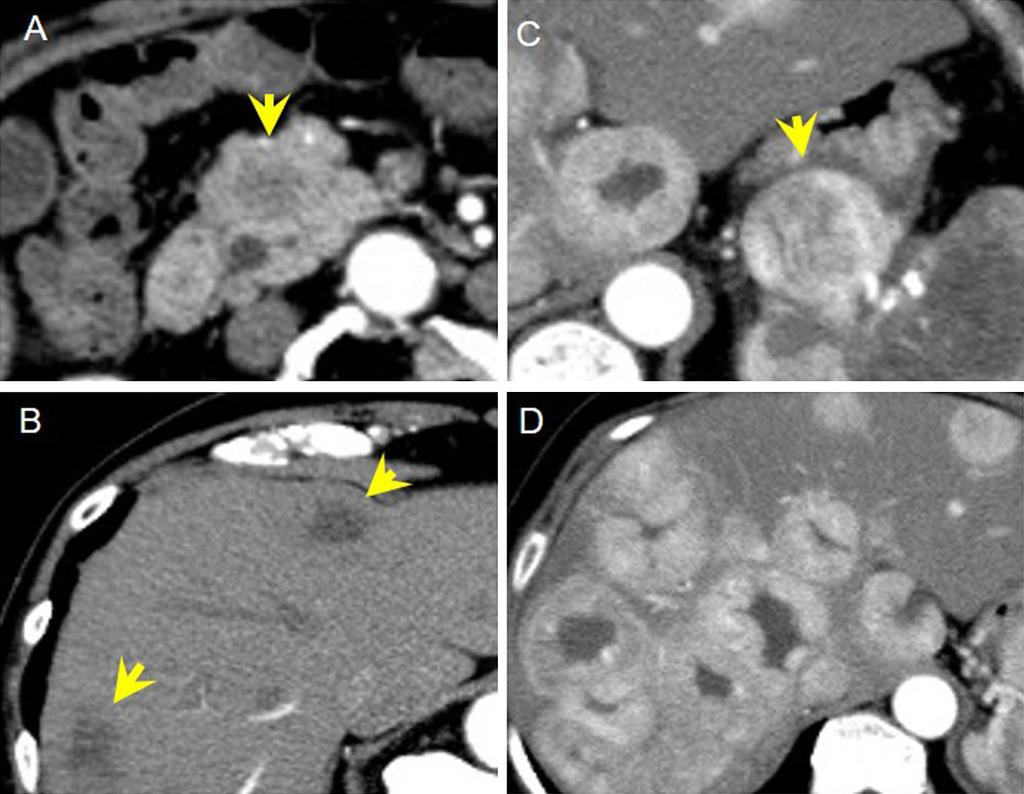 J Gastroenterol (2015) 50:564 572 569 Fig. 2 Computed tomography findings of respective pnecs. a, b Hypovascular lesions both primary pancreas head site and multiple liver lesions (SCNEC case).