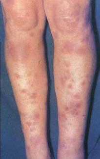 Erythema nodosum Characteristic skin rash - raised nodules on shins May occur in up to 10% of