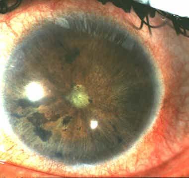 Eye complications Acute red eye associated with relapse of IBD Usually iritis or anterior