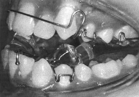 574 Parkin, McKeown, and Sandler American Journal of Orthodontics and Dentofacial Orthopedics June 2001 Fig 1. TB1 appliance; modifications include Adams cribs, ball clasps, and labial bow. Fig 3.