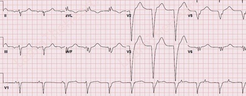 AIVR An accelerated idioventricular rhythm (AIVR) typically occurs during the first 2 days, with