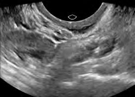 rectum anterior rectosigmoid (Chapron et al.