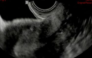 Vesico-uterine pouch Vesico-uterine pouch normal