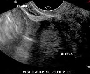Summary Ureters endometriotic nodules infiltrate