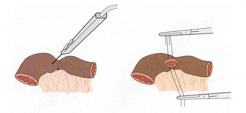 Strictureplasty -