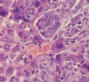 tumor cells of early lung metastases were analyzed and collected by