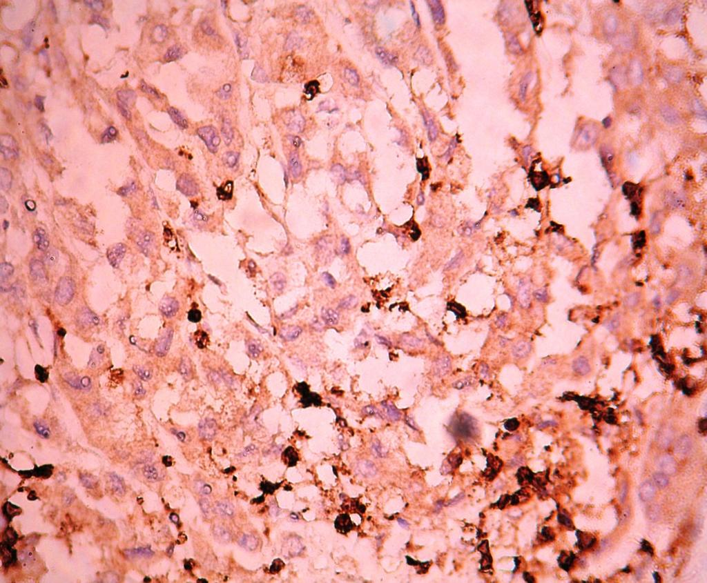 injections of Rigvir IHC after