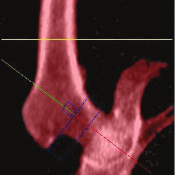 2D-Fan Beam Whole Body Densitometer Advanced Morphometrictools Fracture risk information using Hip Structural Analysis (HSA) Diagnostic tools Examination sites AP spine (L1- L4) Forearm: Ultradistal,
