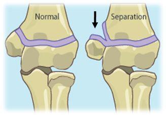 Posterior dislocations of the joint are common in children because the parts of the bones that stabilize the joint are incompletely developed.