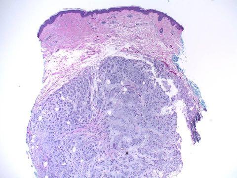 True chondroid syringoma: cartilaginous and syringeal Microcystic adnexal carcinoma (MAC) Rare,