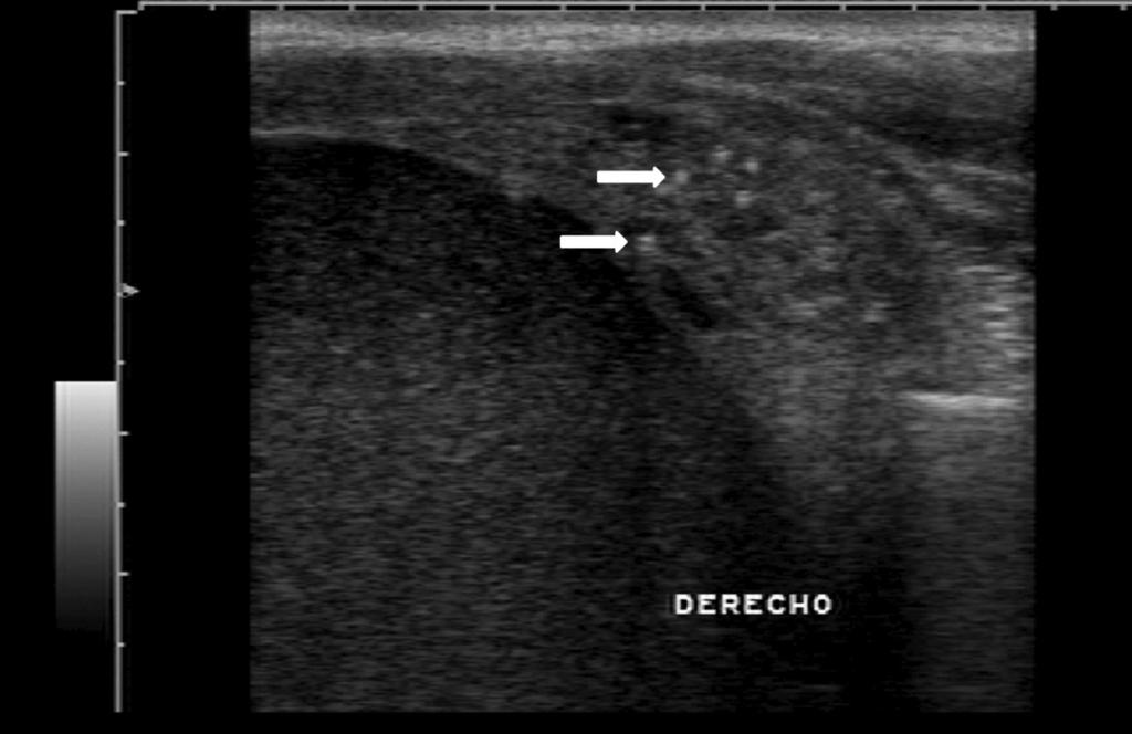 Fig. 2: Papillary thyroid carcinoma: Sonogram of the right lobe of the thyroid demonstrates punctate echogenic foci with and without