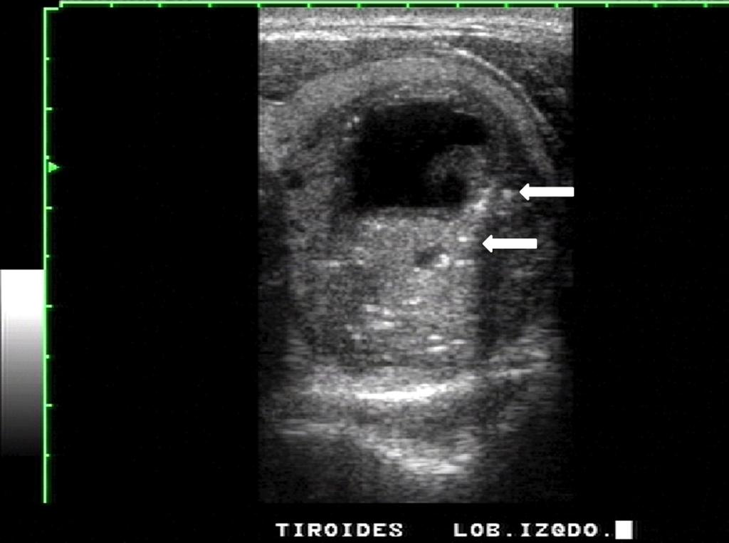 Fig. 4: Medullary thyroid carcinoma: Transverse sonogram of the left lobe of the thyroid shows a predominantly solid and