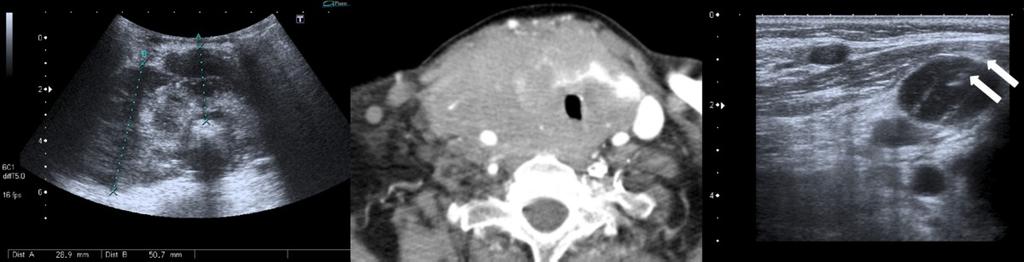 macrocalcifications, which corresponded to a anaplastic thyroid carcinoma. CT confirmed calcifications and showed muscular invasion, as well as pulmonary metastasis (not showed). Fig.