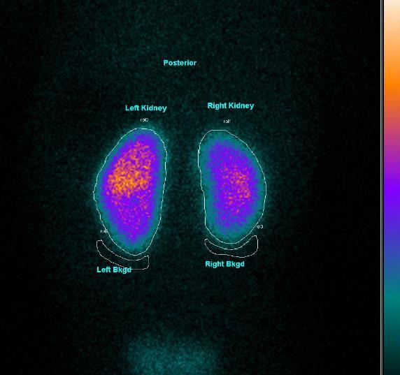 3.RENAL SCINTIGRAPHY Estimation of Clinical Quantitative Parameters: Kidneys ROIs* Relative Renal Function (RRF) - 99m Tc-DMSA renal uptake The geometric mean (GM) method is used
