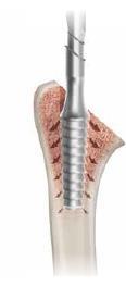 Instrumentation Feature: Bone Compacting Instrumentation