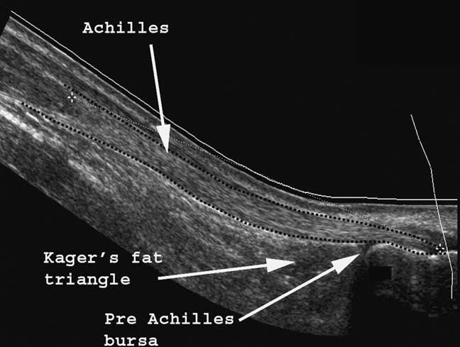 A Z of Musculoskeletal and Trauma Radiology Ultrasound of a normal Achilles tendon. Achilles tendonopathy.