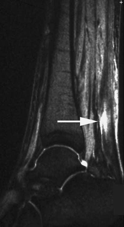 A Z of Musculoskeletal and Trauma Radiology Sagittal STR MR: High signal within the